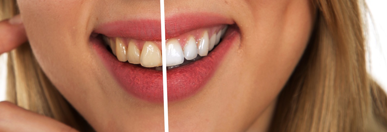 sbiancamento denti